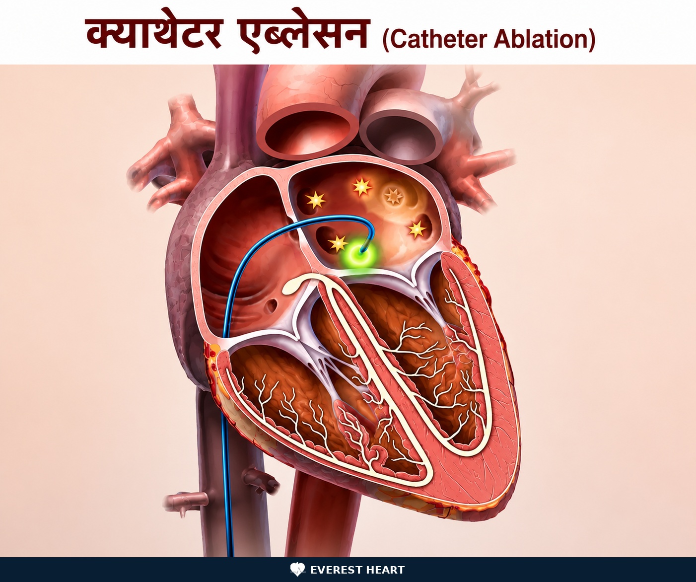 क्याथेटर एब्लेसन प्रक्रिया देखाउने चित्र: रक्तनलीमार्फत क्याथेटर हृदयसम्म पुर्‍याई असामान्य विद्युतीय संकेत उत्पन्न हुने ठाउँमा ऊर्जा प्रयोग गरिँदै