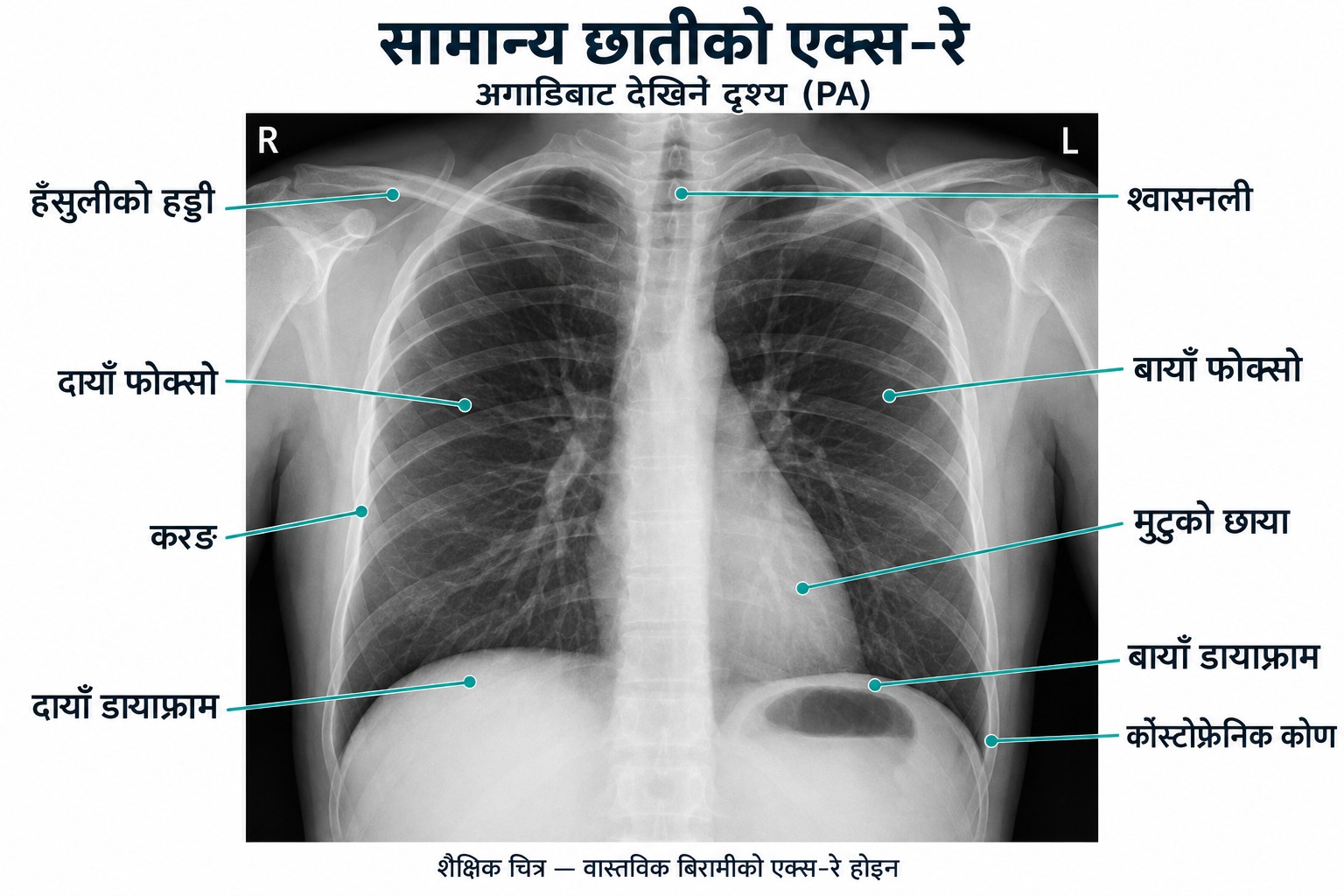 सामान्य छातीको एक्स-रे (PA दृश्य) — हँसुली हड्डी, श्वासनली, दायाँ र बायाँ फोक्सो, मुटुको छाया, डायाफ्राम र कोस्टोफ्रेनिक कोण लेबल गरिएको शैक्षिक चित्र