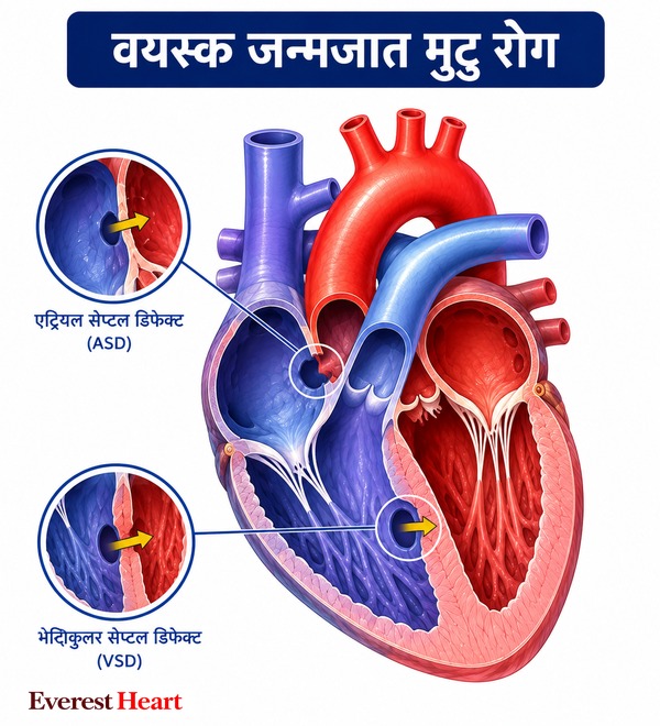 वयस्क जन्मजात मुटु रोग: एट्रियल सेप्टल डिफेक्ट (ASD) र भेन्ट्रिकुलर सेप्टल डिफेक्ट (VSD) देखाउने चित्र
