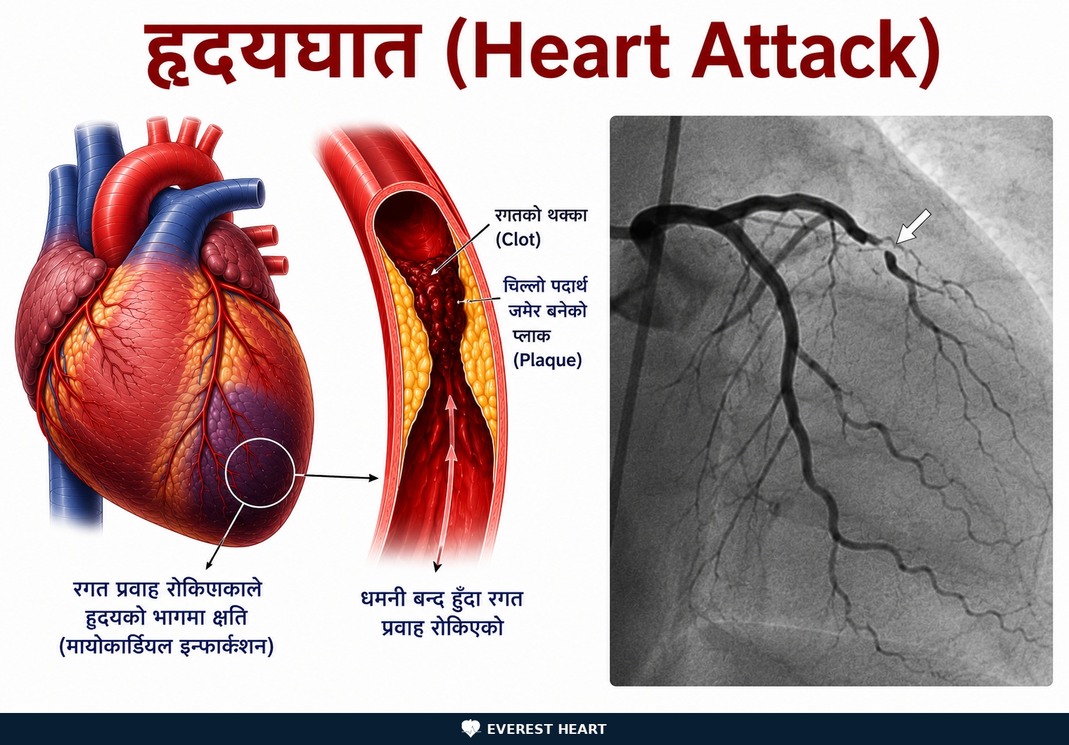 हृदयाघातका आपतकालीन संकेत