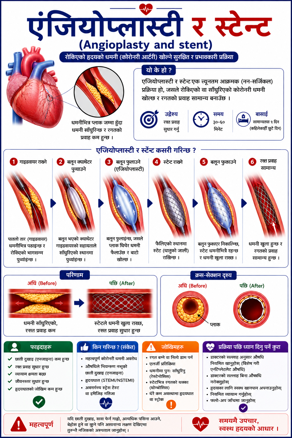 एंजियोप्लास्टी र स्टेन्ट