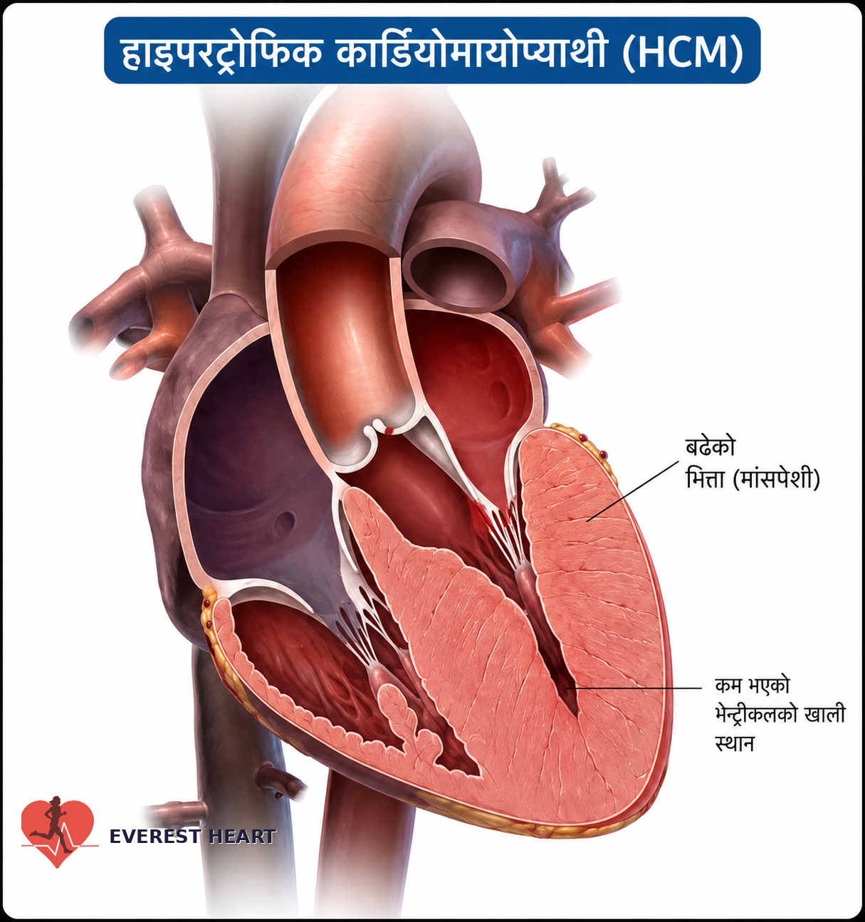 हाइपरट्रोफिक कार्डियोमायोप्याथीमा मुटुको भित्ता बाक्लो भई भेन्ट्रिकलको खाली स्थान कम हुनु