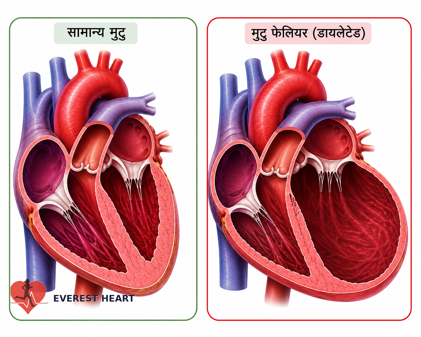 सामान्य मुटु र फैलिएर कमजोर भएको (dilated) मुटु बीचको तुलना