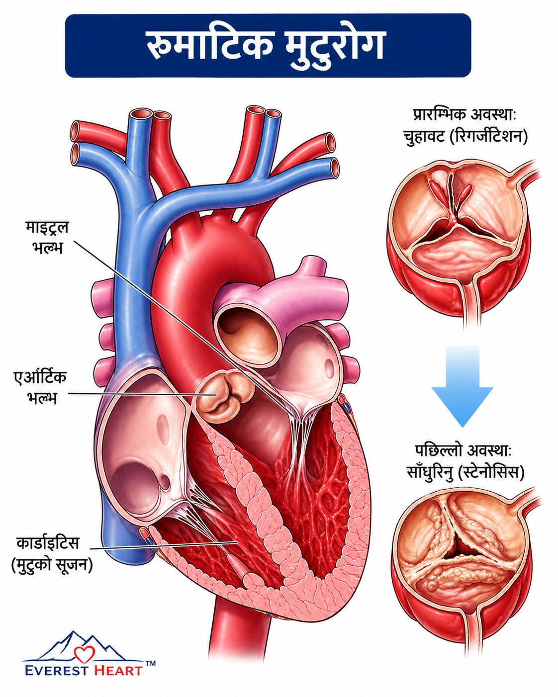 रुमेटिक मुटुरोगले माइट्रल र एओर्टिक भल्भमा पार्ने असर — प्रारम्भिक चुहावटदेखि पछिल्लो साँघुरोपनसम्म