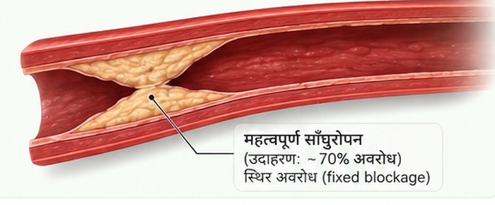 कोरोनरी धमनीमा उल्लेख्य स्थिर साँघुरोपन