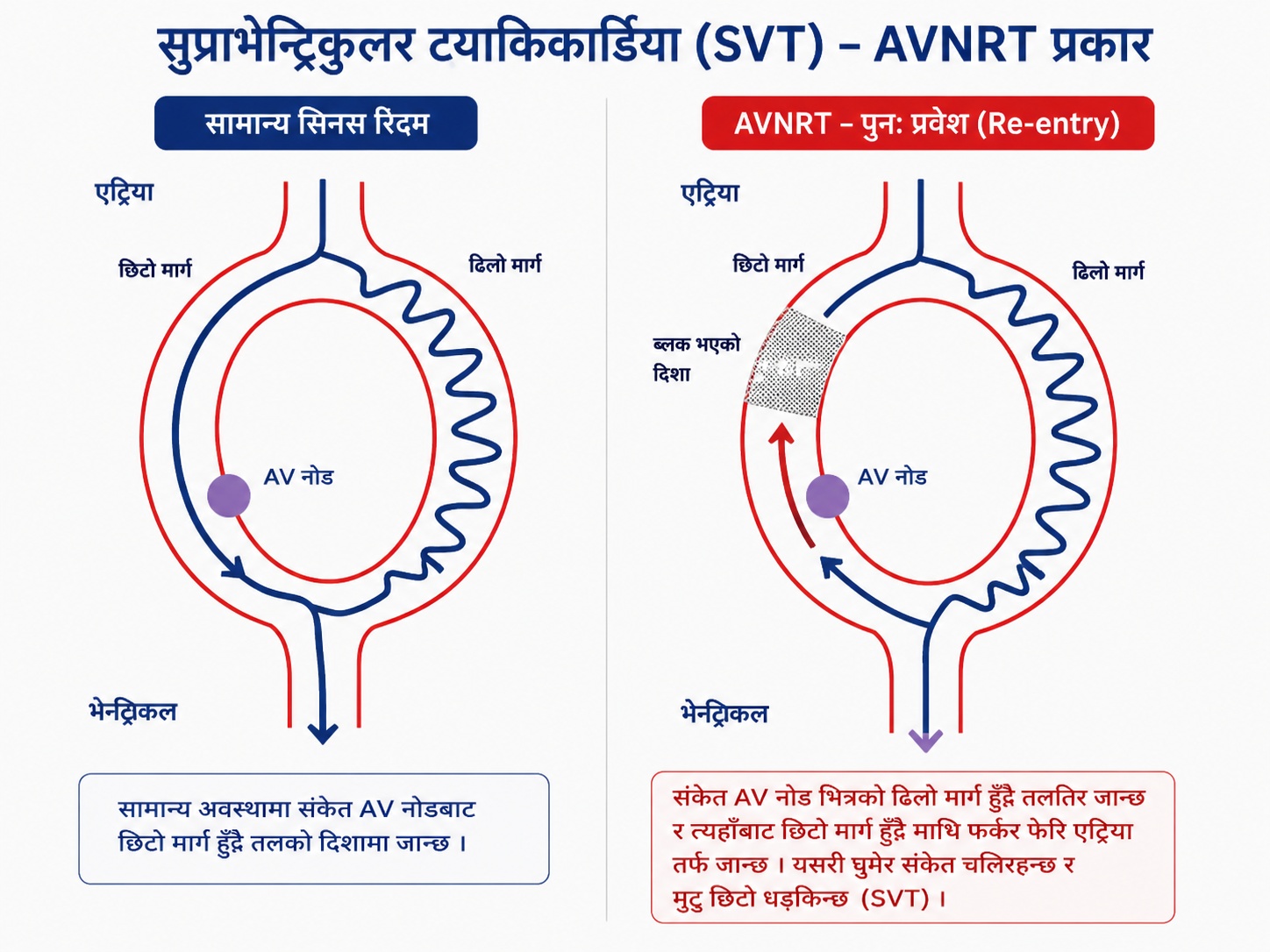 सामान्य साइनस लय र AVNRT मा हुने पुनःप्रवेश (Re-entry) मार्गको तुलनात्मक चित्र