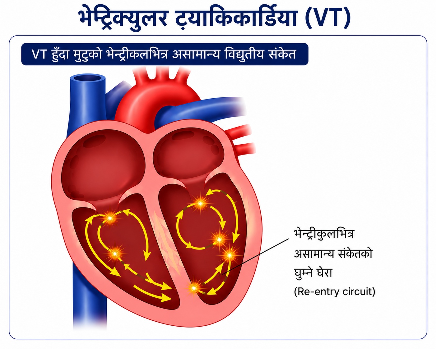 VT हुँदा मुटुको भेन्ट्रिकलभित्र असामान्य विद्युतीय संकेत घुम्ने मार्गको चित्र